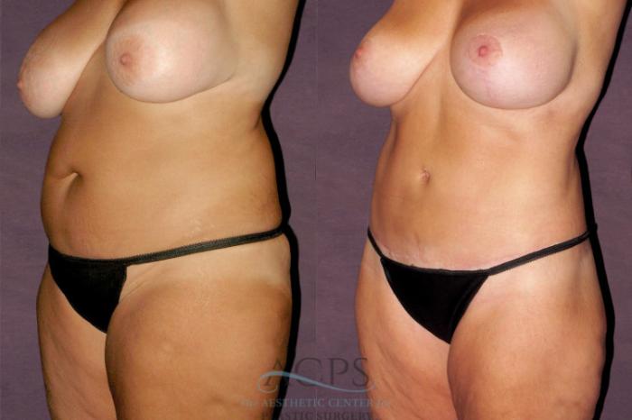 Before & After Tummy Tuck Case 146 Oblique Left View: View in Houston, TX