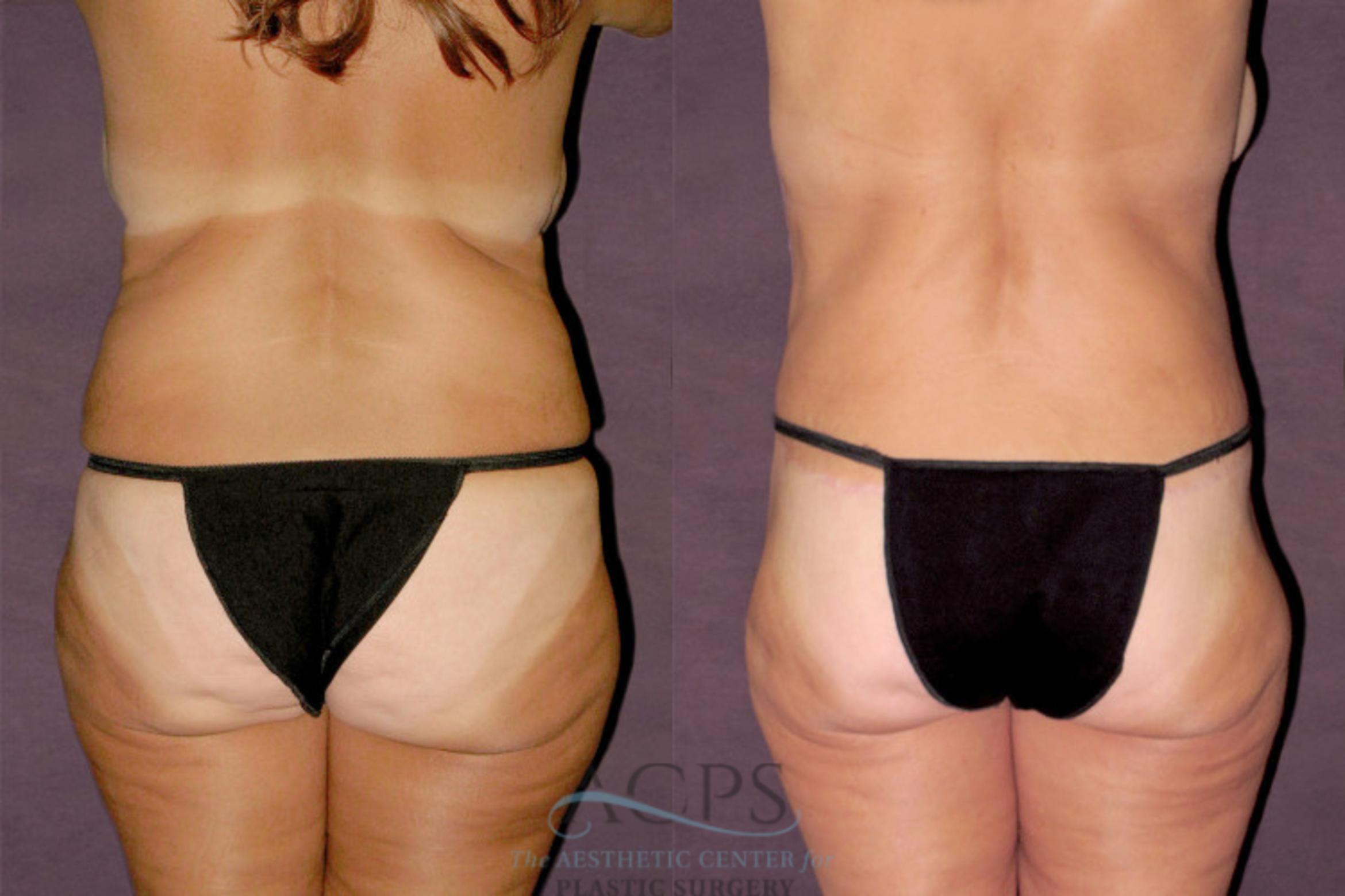 Before & After Tummy Tuck Case 146 Rear View: View in Houston, TX