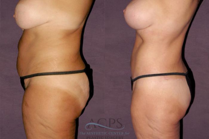 Before & After Tummy Tuck Case 146 Side Left View: View in Houston, TX