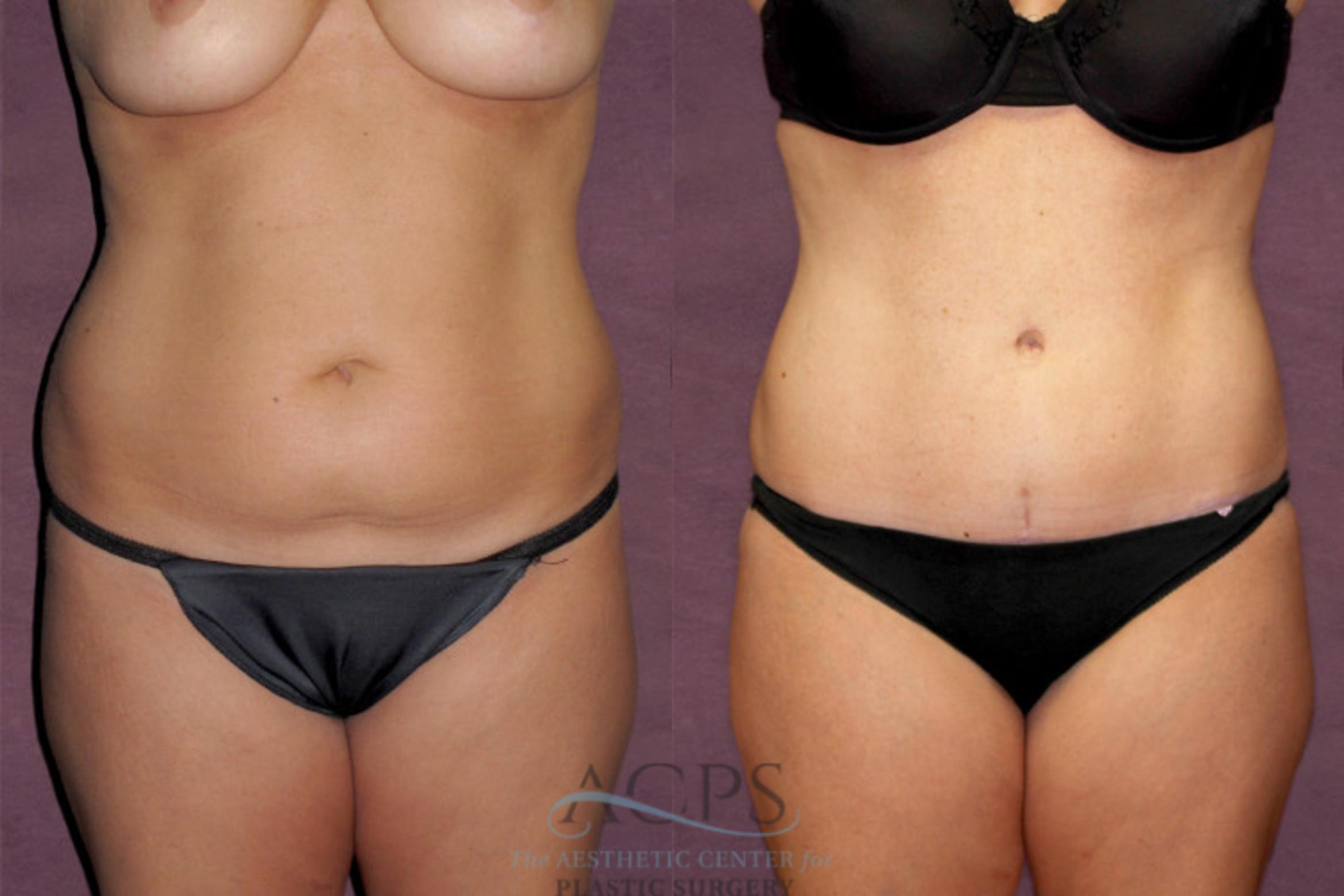 Before & After Tummy Tuck Case 147 Front View: View in Houston, TX