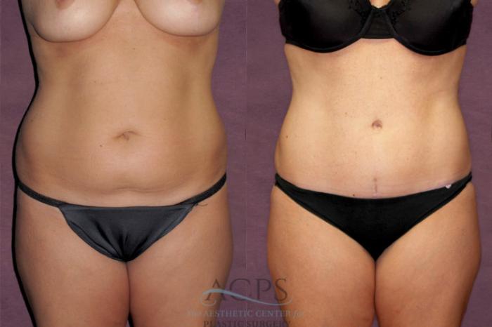 Before & After Tummy Tuck Case 147 Front View: View in Houston, TX