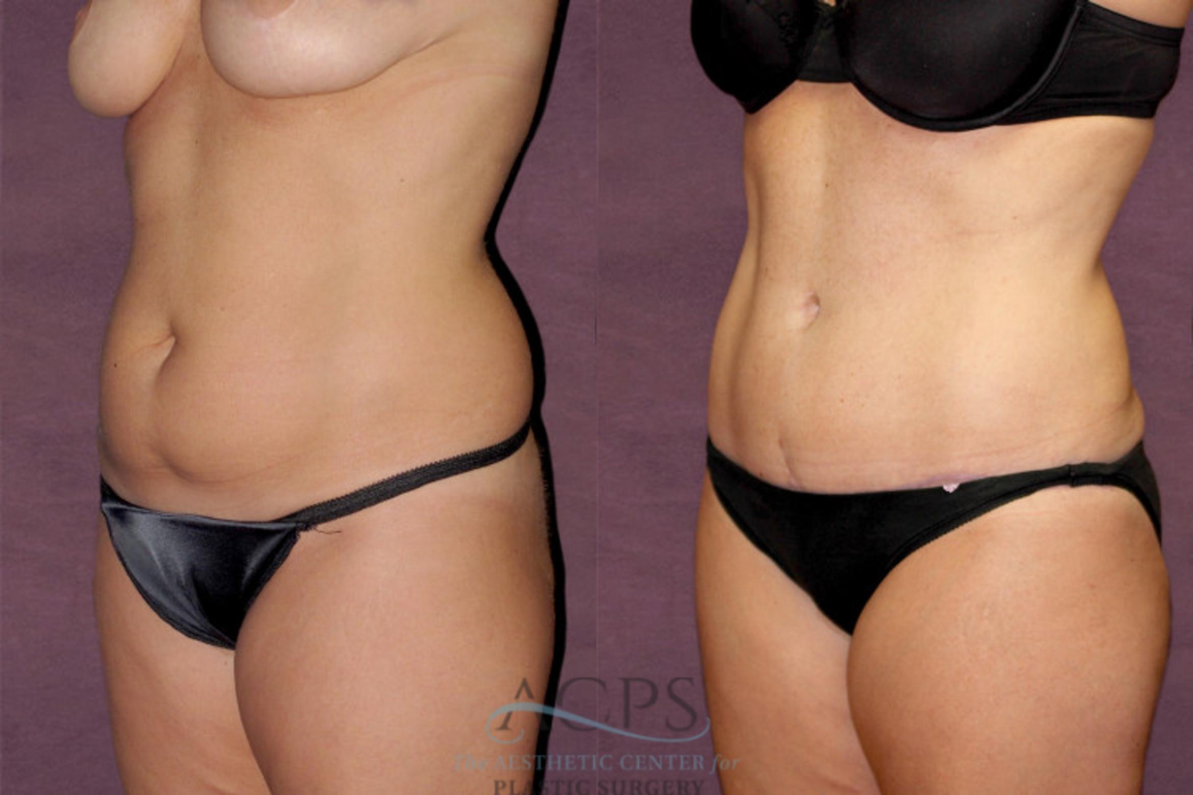 Before & After Tummy Tuck Case 147 Oblique Left View: View in Houston, TX
