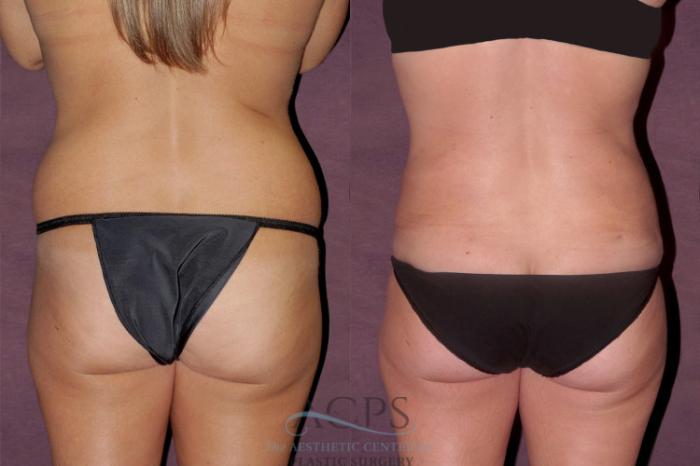 Before & After Tummy Tuck Case 147 Rear View: View in Houston, TX
