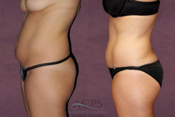 Before & After Tummy Tuck Case 147 Side Left View: View in Houston, TX