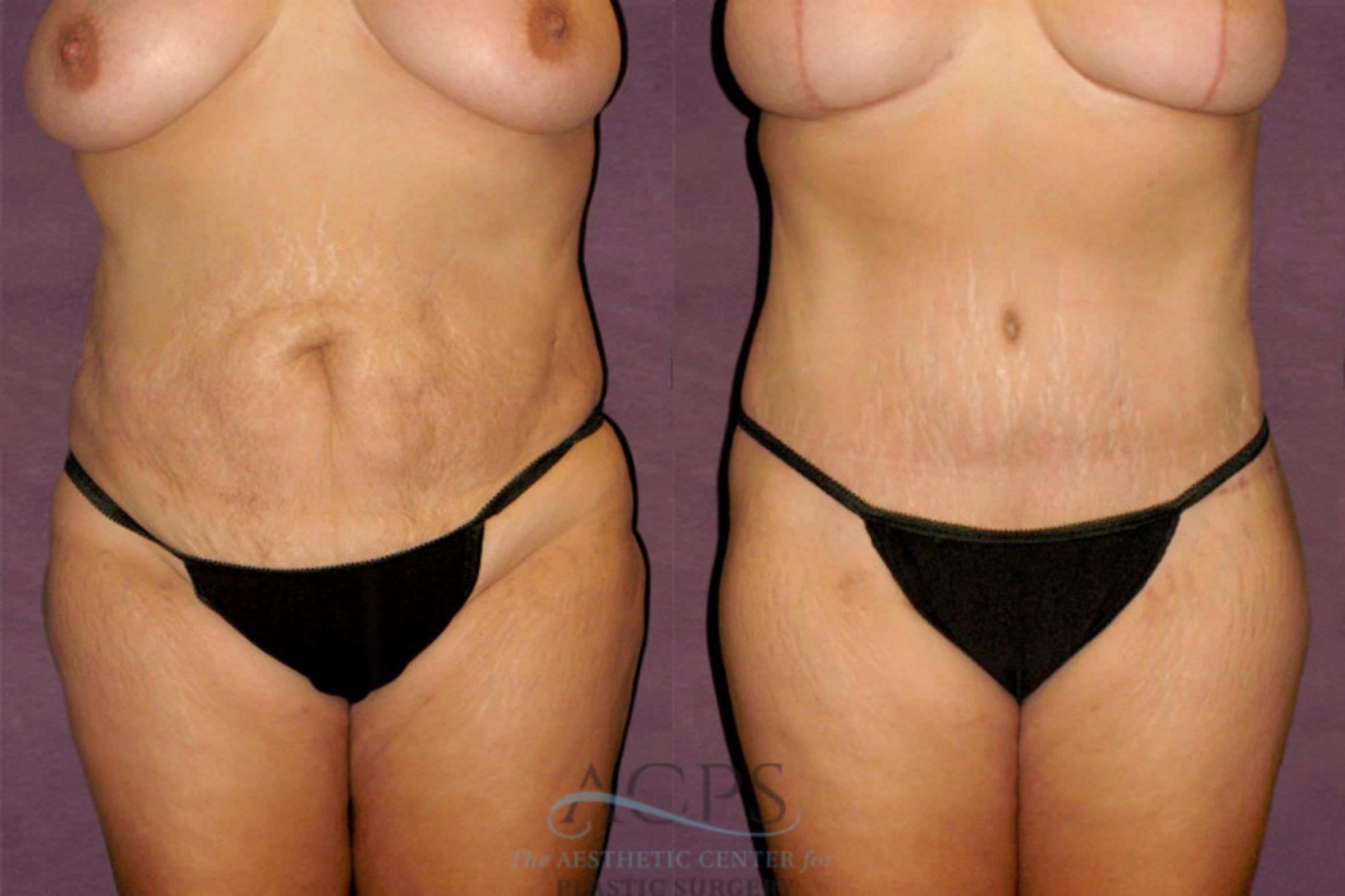 Before & After Mommy Makeover Case 148 Front View: View in Houston, TX