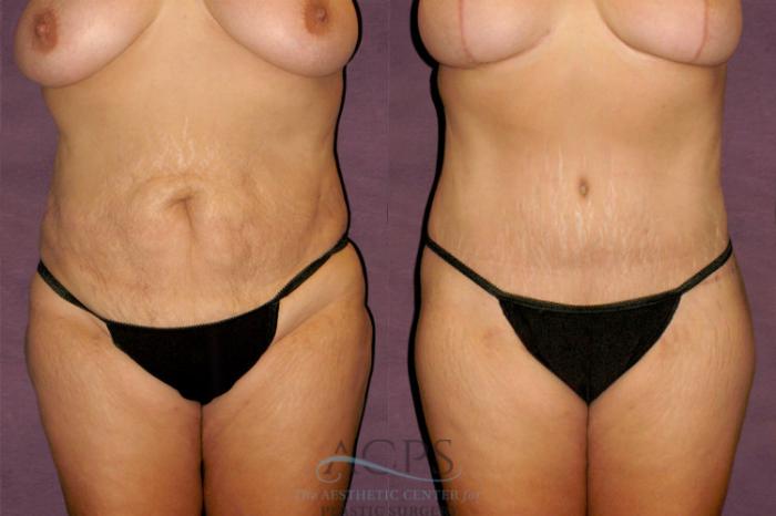 Before & After Mommy Makeover Case 148 Front View: View in Houston, TX