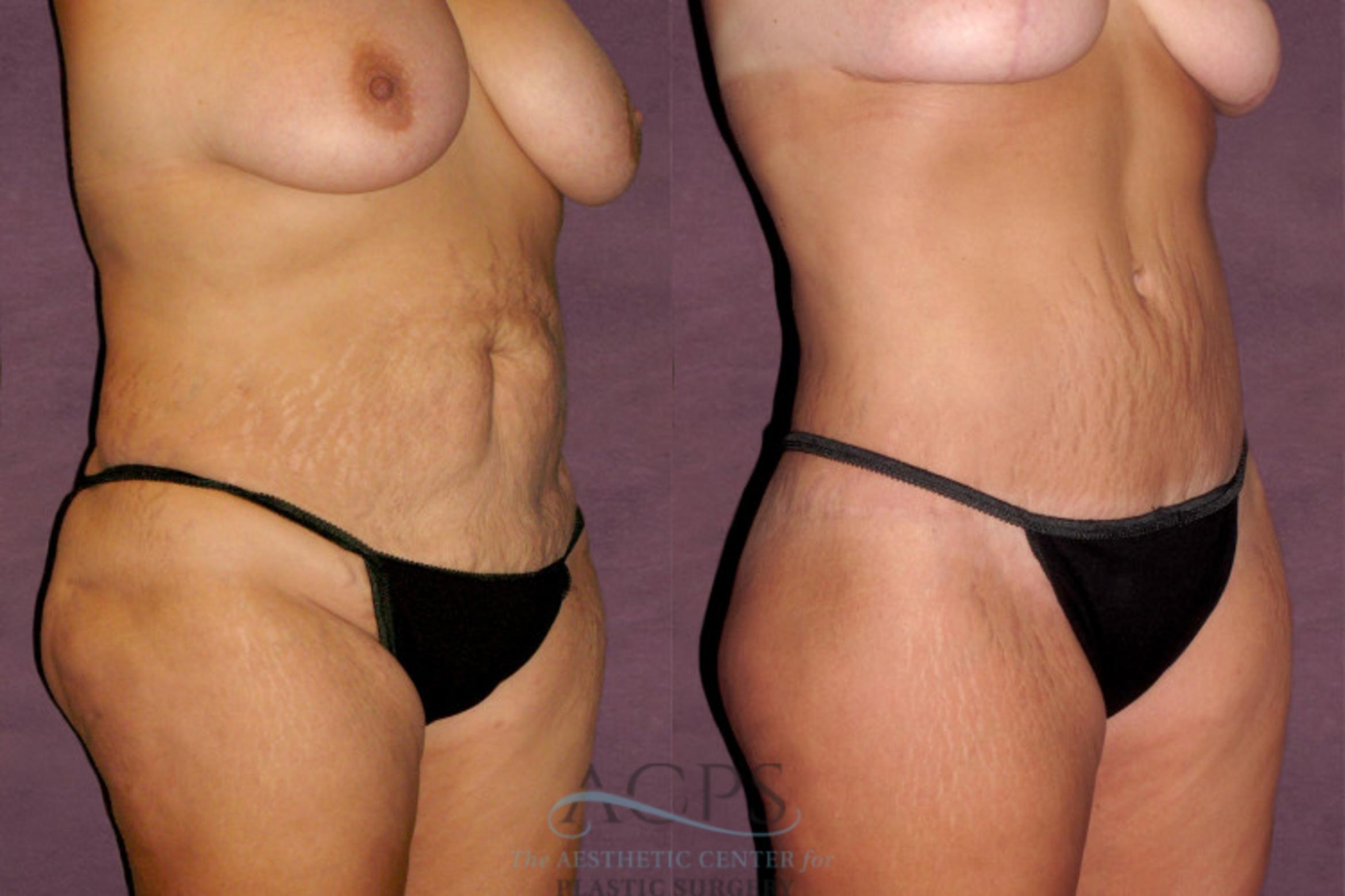 Before & After Mommy Makeover Case 148 Oblique Right View: View in Houston, TX