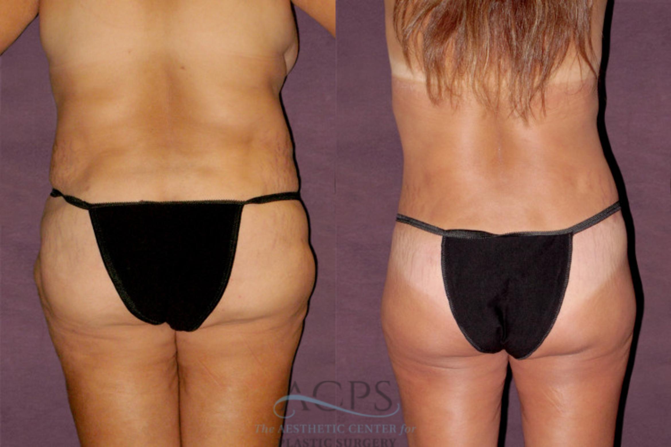 Before & After Mommy Makeover Case 148 Rear View: View in Houston, TX