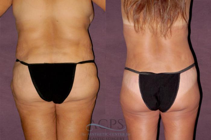 Before & After Mommy Makeover Case 148 Rear View: View in Houston, TX