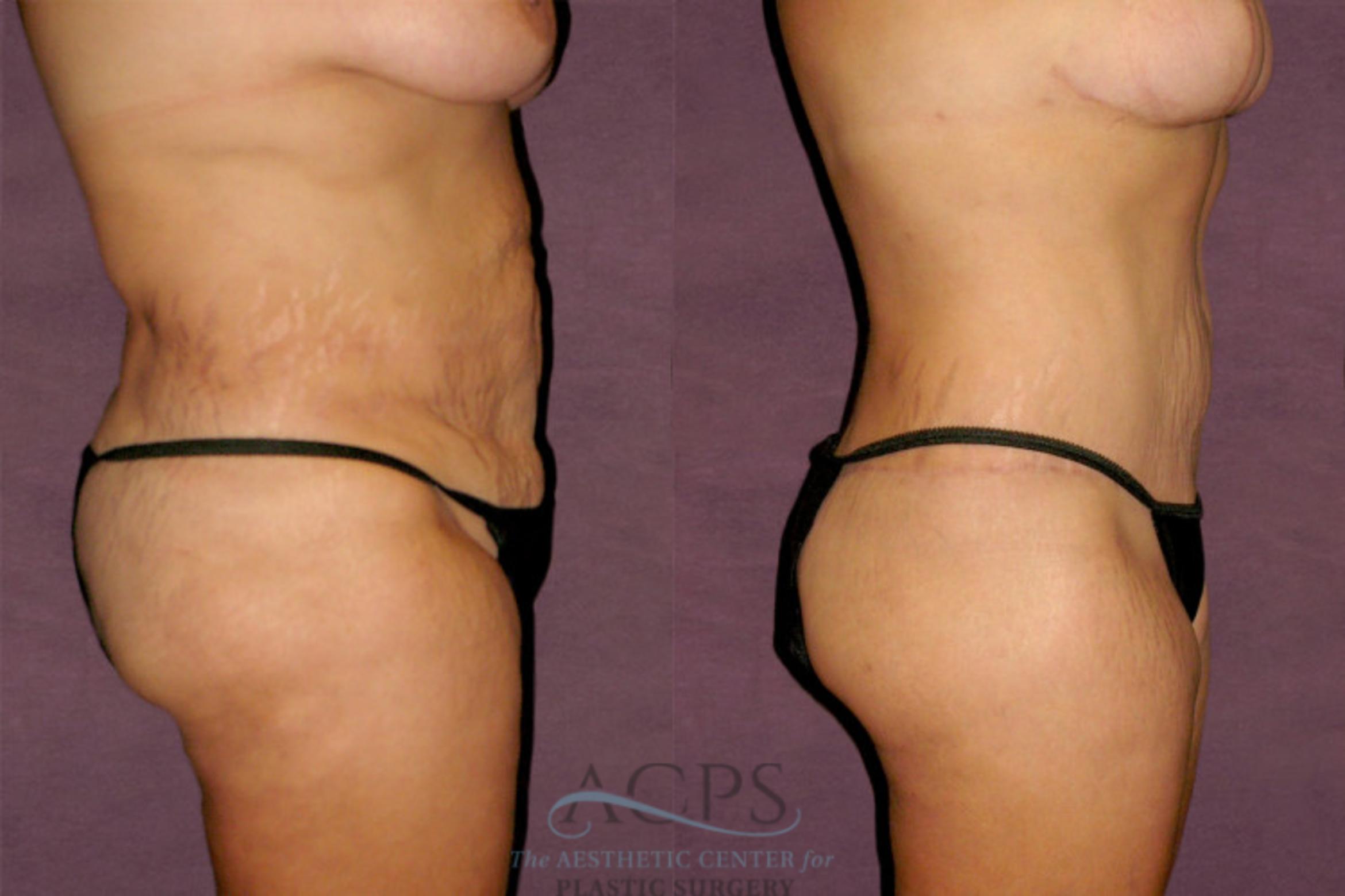 Before & After Mommy Makeover Case 148 Side Right View: View in Houston, TX