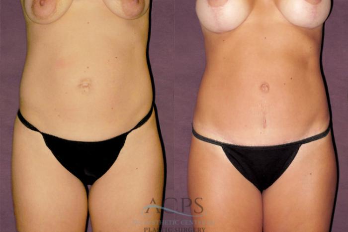Before & After Tummy Tuck Case 149 Front View: View in Houston, TX