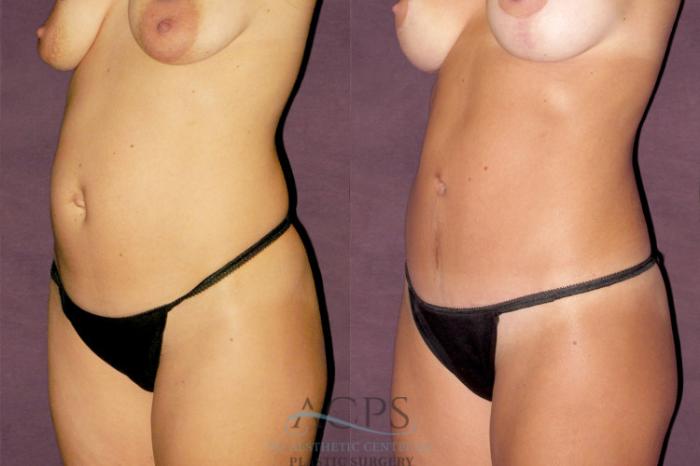 Before & After Tummy Tuck Case 149 Oblique Left View: View in Houston, TX