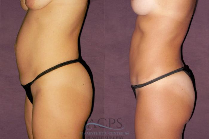 Before & After Tummy Tuck Case 149 Side Left View: View in Houston, TX