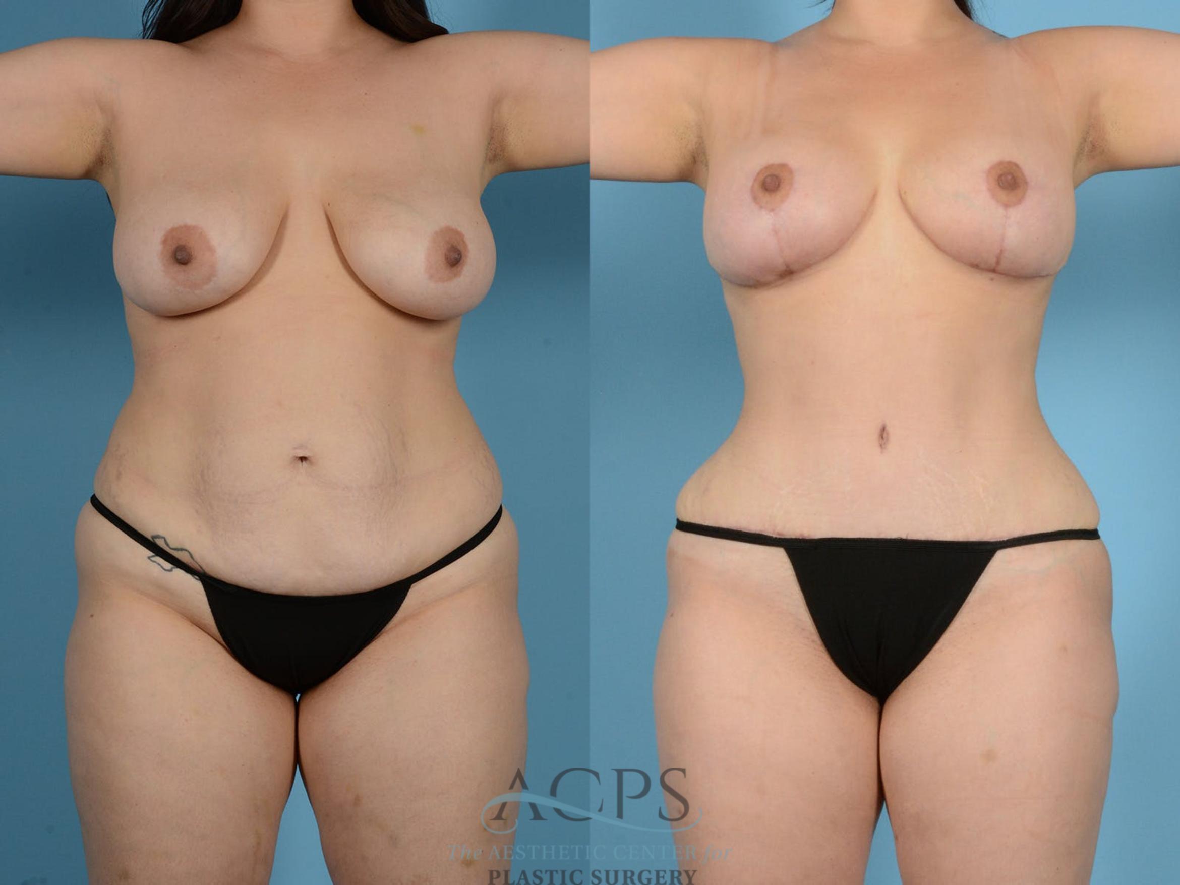 Before & After Tummy Tuck Case 15 Front View: View in Houston, TX