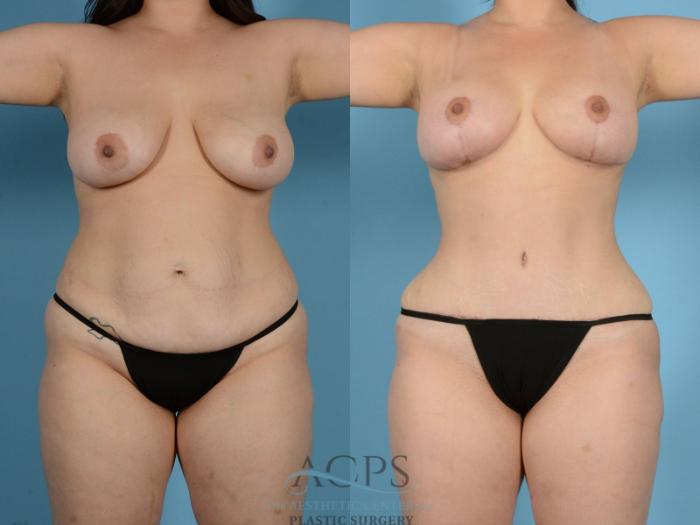 Before & After Tummy Tuck Case 15 Front View: View in Houston, TX