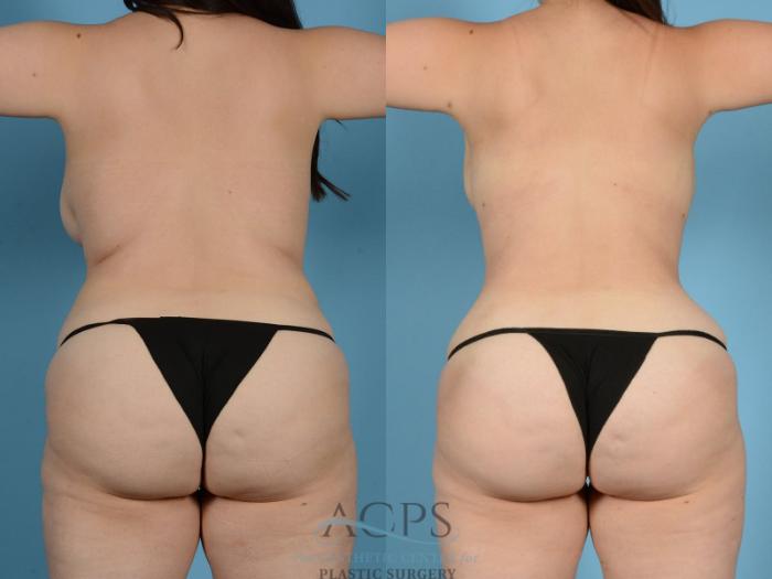 Before & After Tummy Tuck Case 15 Rear View: View in Houston, TX