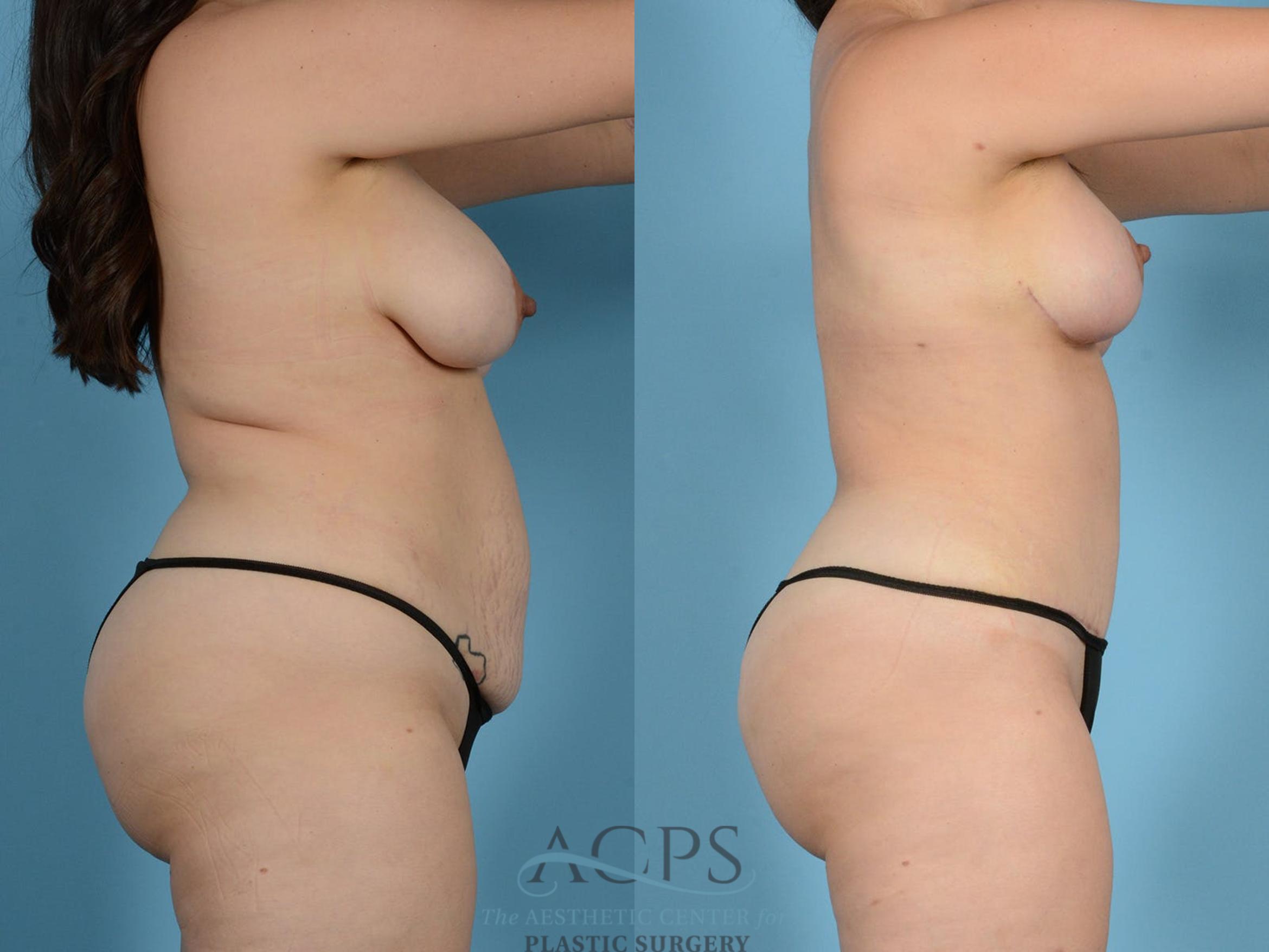 Before & After Tummy Tuck Case 15 Side View: View in Houston, TX