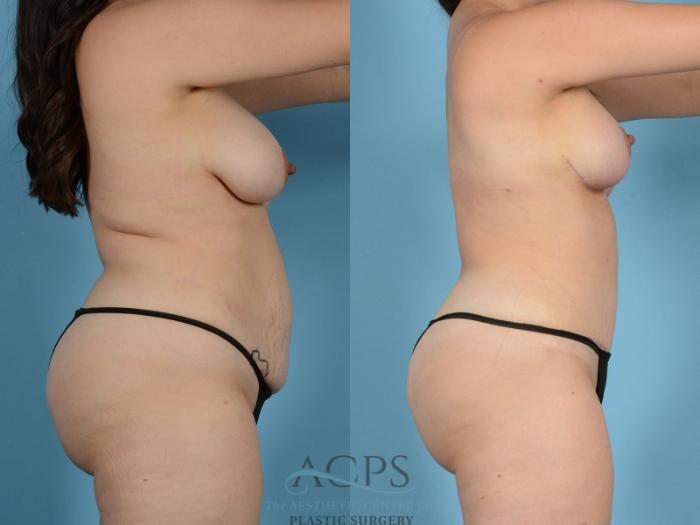 Before & After Tummy Tuck Case 15 Side View: View in Houston, TX
