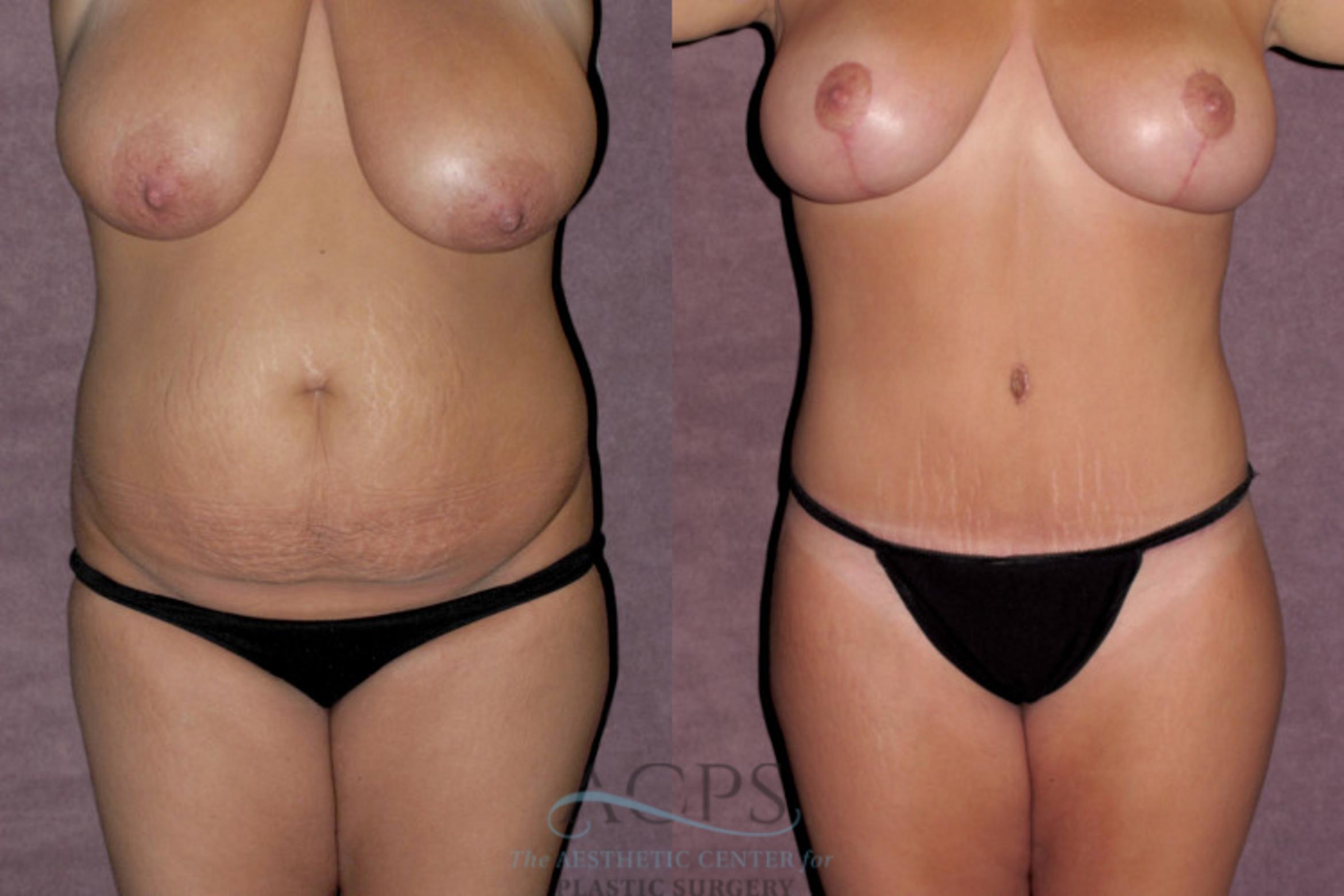 Before & After Tummy Tuck Case 150 Front View: View in Houston, TX