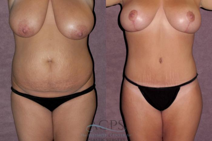 Before & After Tummy Tuck Case 150 Front View: View in Houston, TX