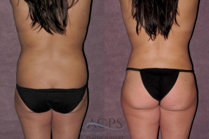 Before & After Tummy Tuck Case 150 Rear View: View in Houston, TX
