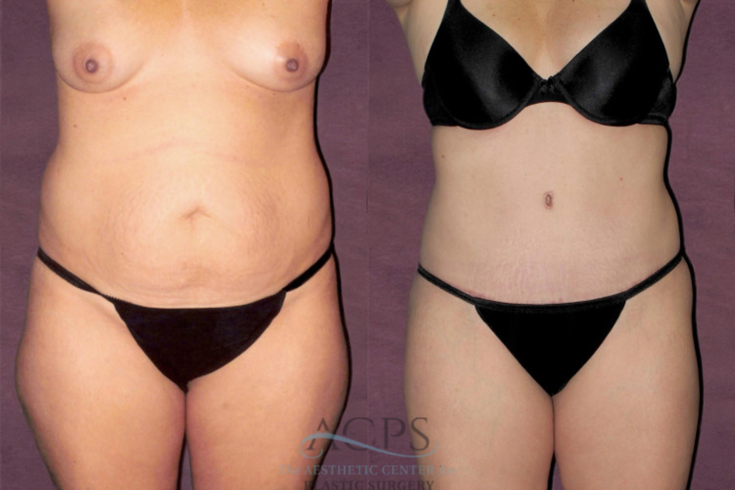 Before & After Tummy Tuck Case 151 Front View: View in Houston, TX