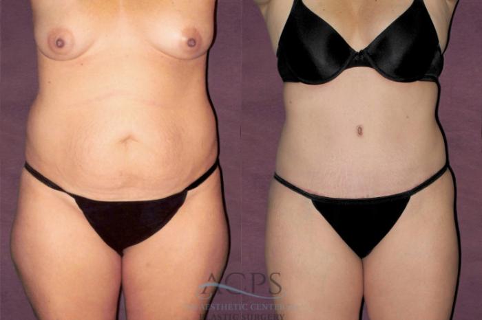 Before & After Tummy Tuck Case 151 Front View: View in Houston, TX
