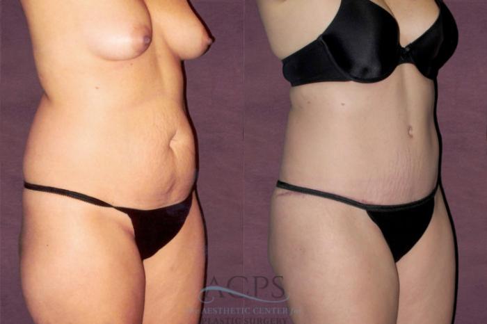 Before & After Tummy Tuck Case 151 Oblique Right View: View in Houston, TX