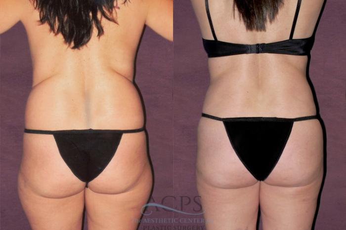 Before & After Tummy Tuck Case 151 Rear View: View in Houston, TX