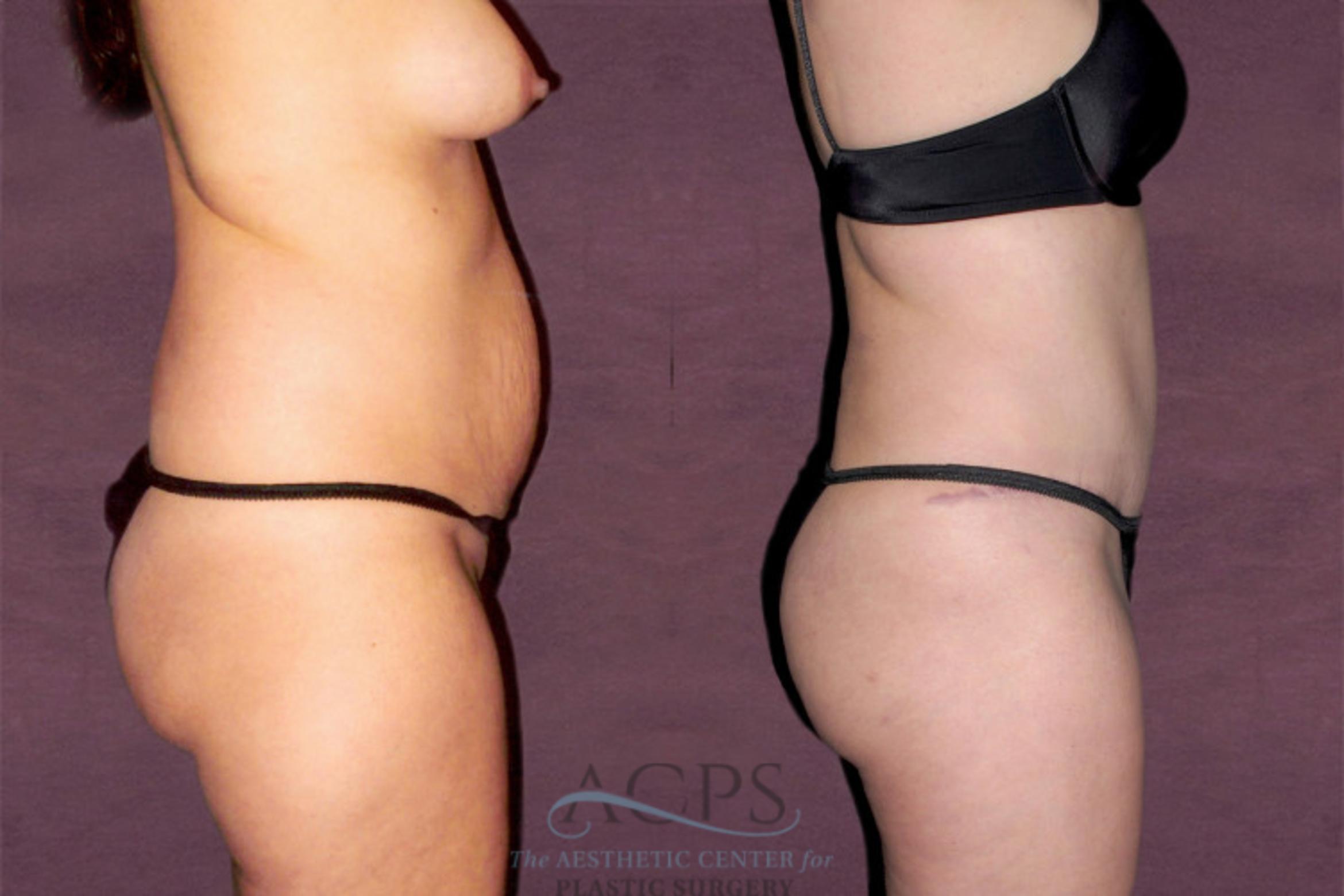 Before & After Tummy Tuck Case 151 Side Right View: View in Houston, TX