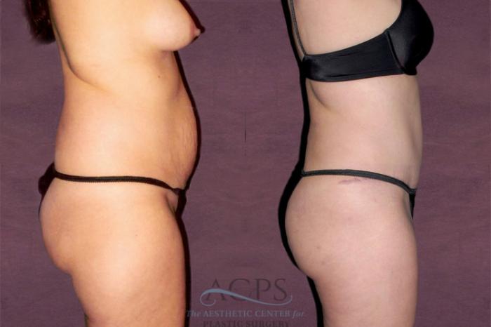 Before & After Tummy Tuck Case 151 Side Right View: View in Houston, TX