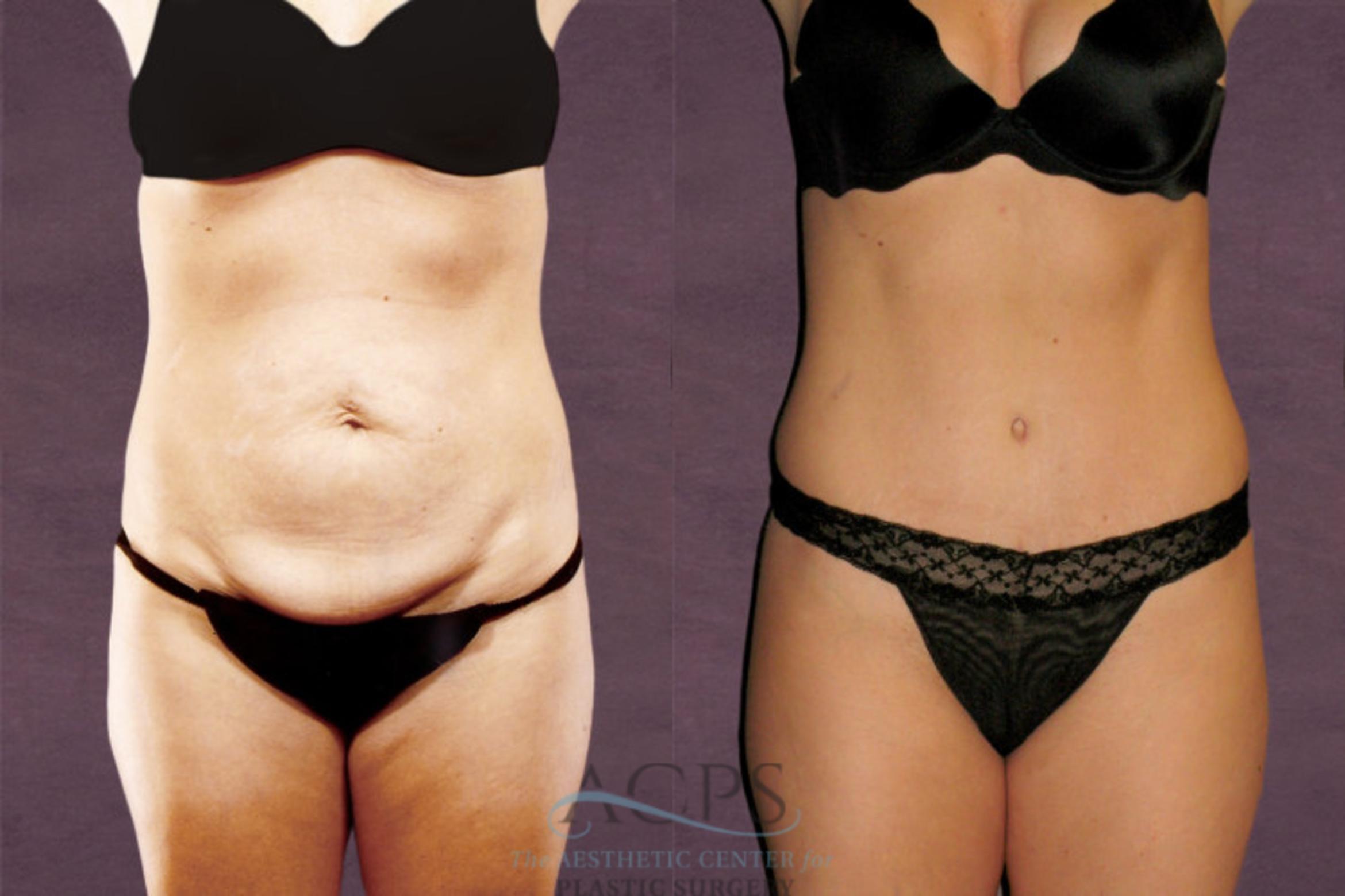 Before & After Tummy Tuck Case 152 Front View: View in Houston, TX