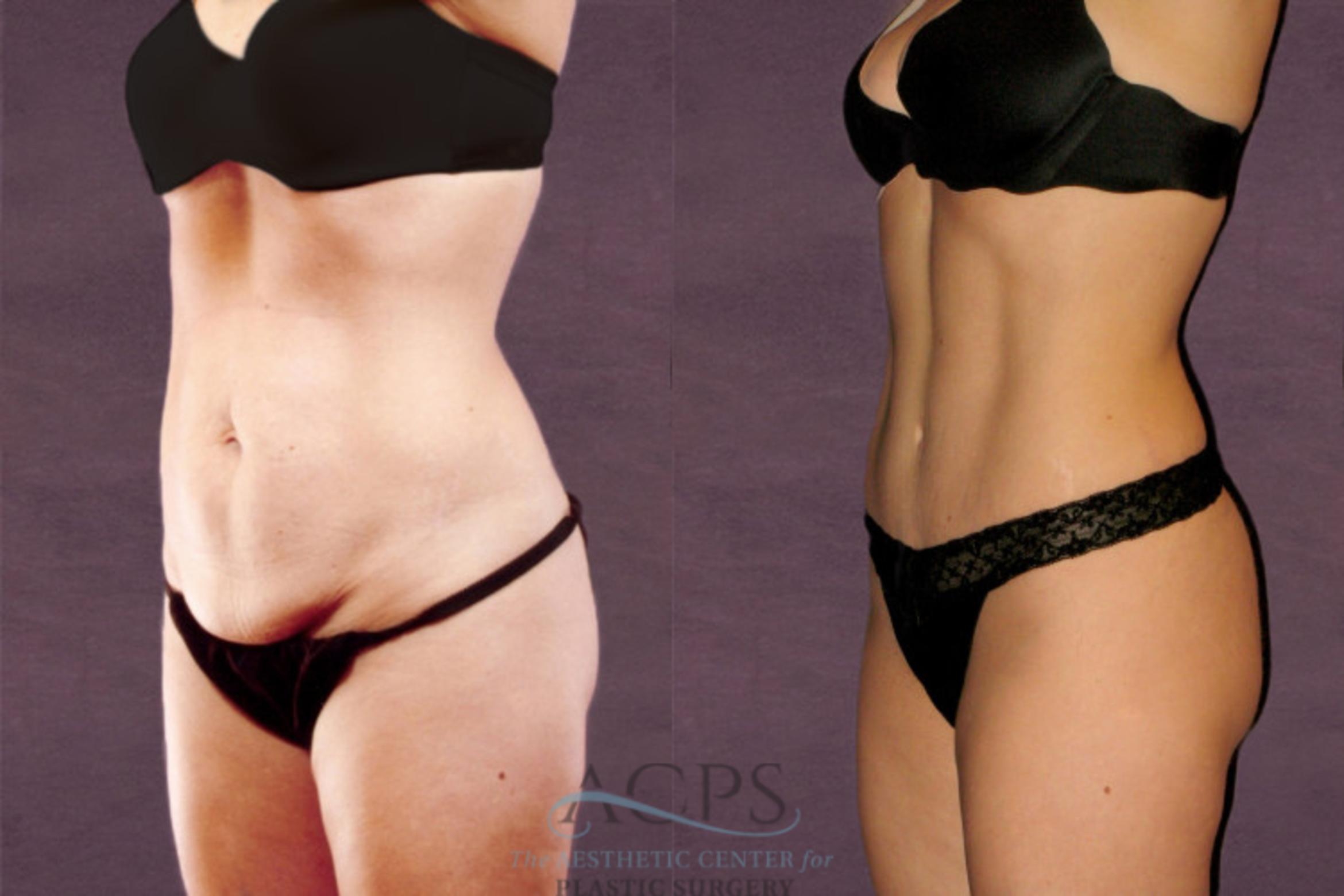 Before & After Tummy Tuck Case 152 Oblique Left View: View in Houston, TX