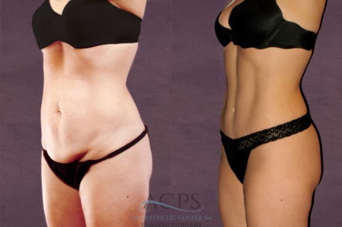 Before & After Tummy Tuck Case 152 Oblique Left View: View in Houston, TX