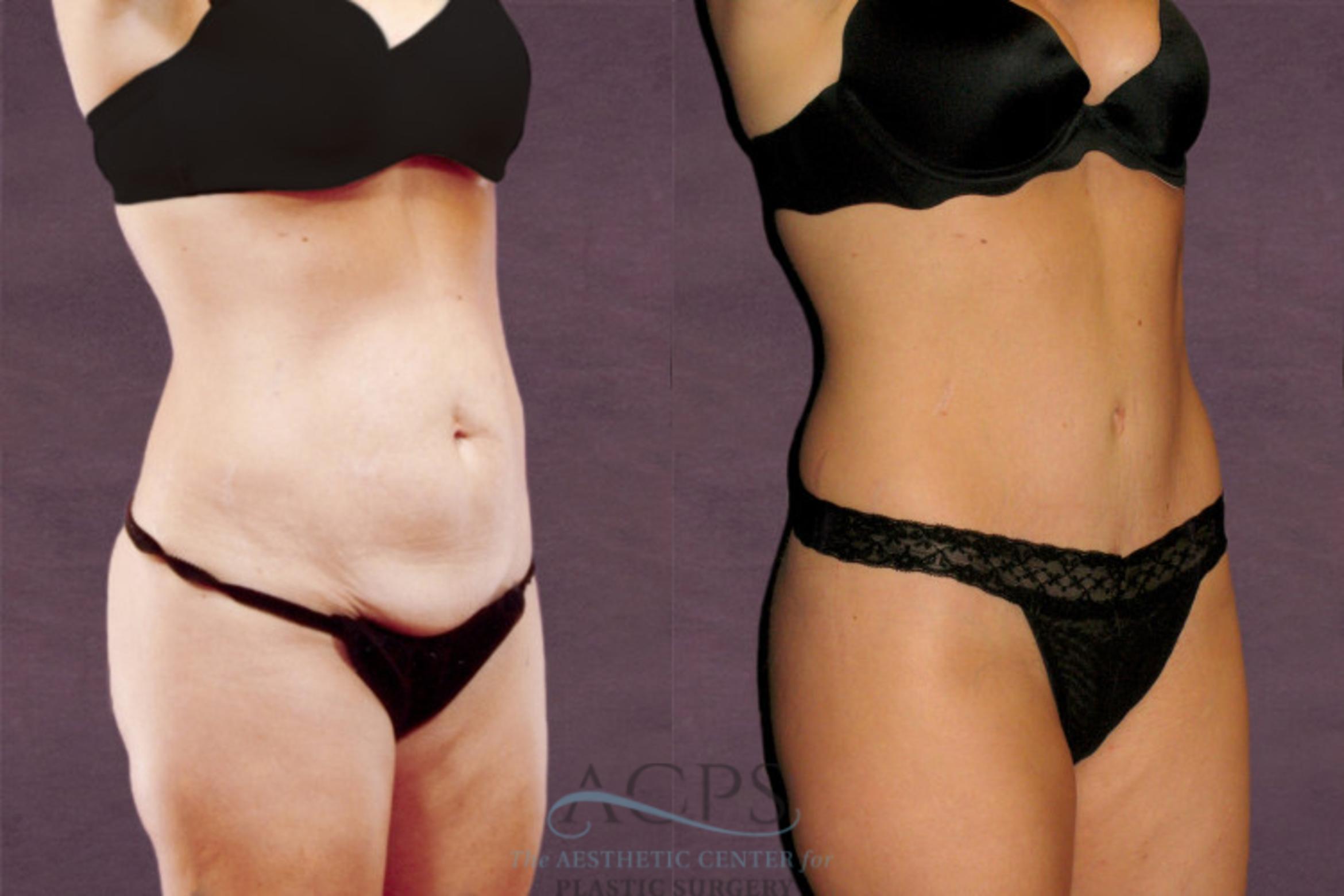 Before & After Tummy Tuck Case 152 Oblique Right View: View in Houston, TX