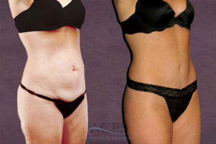 Before & After Tummy Tuck Case 152 Oblique Right View: View in Houston, TX
