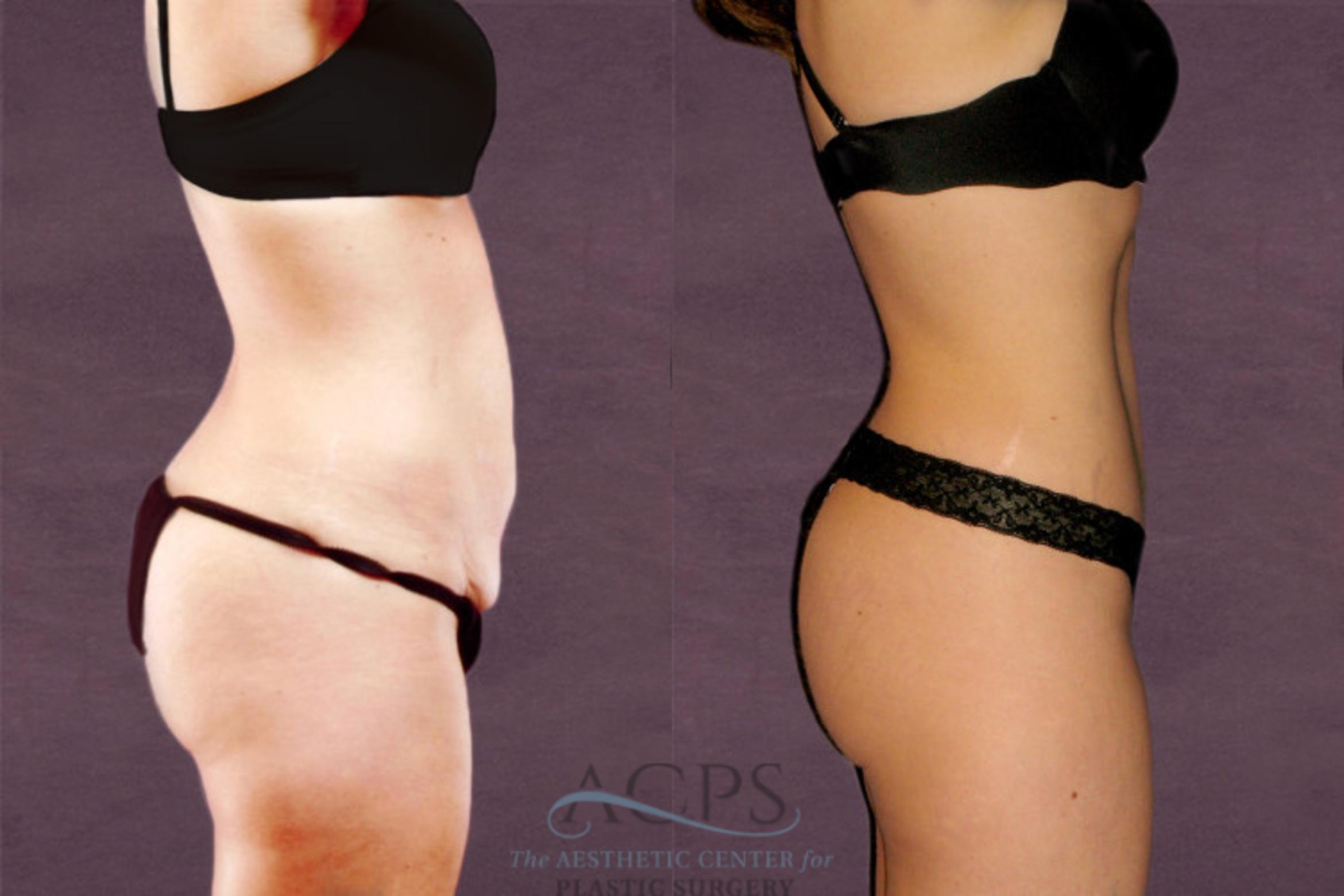 Before & After Tummy Tuck Case 152 Side Right View: View in Houston, TX