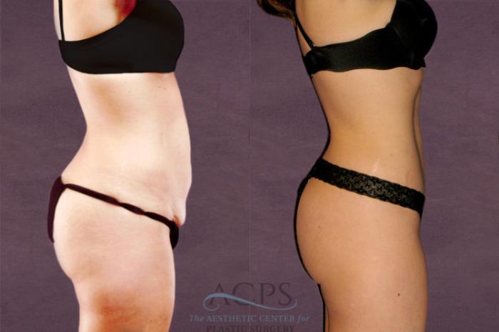 Before & After Tummy Tuck Case 152 Side Right View: View in Houston, TX