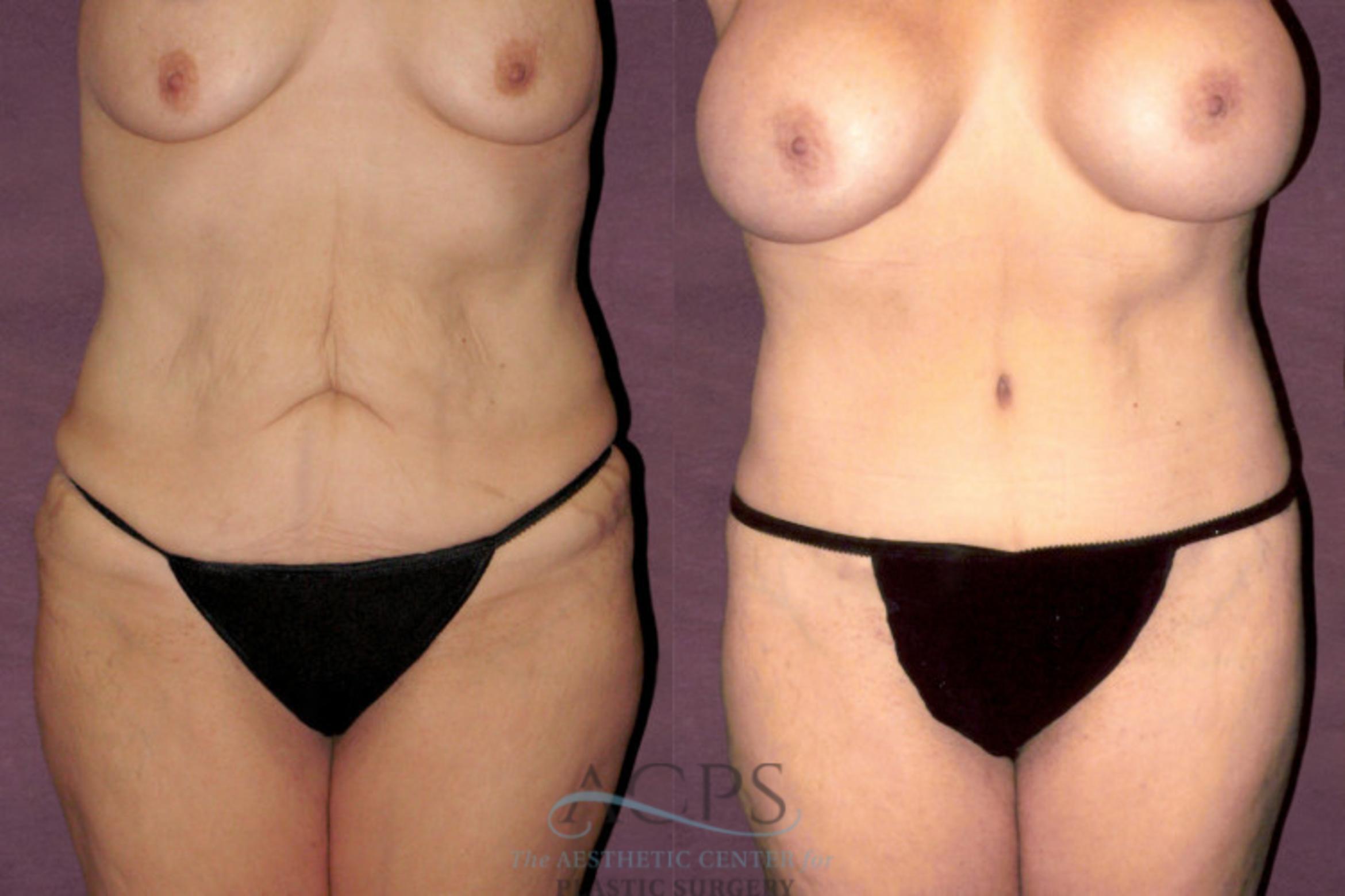 Before & After Tummy Tuck Case 153 Front View: View in Houston, TX