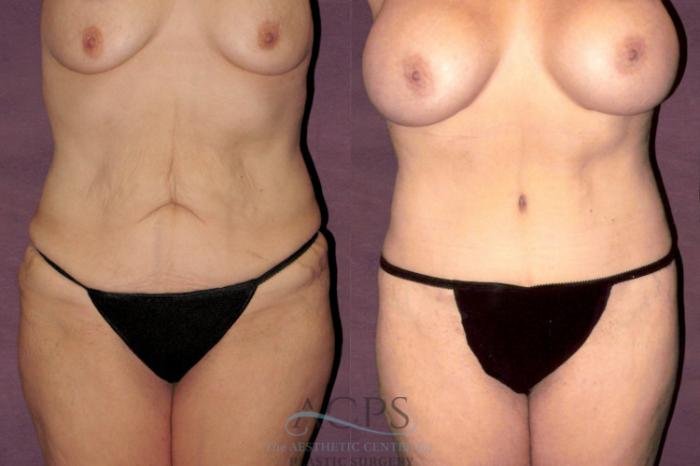 Before & After Tummy Tuck Case 153 Front View: View in Houston, TX