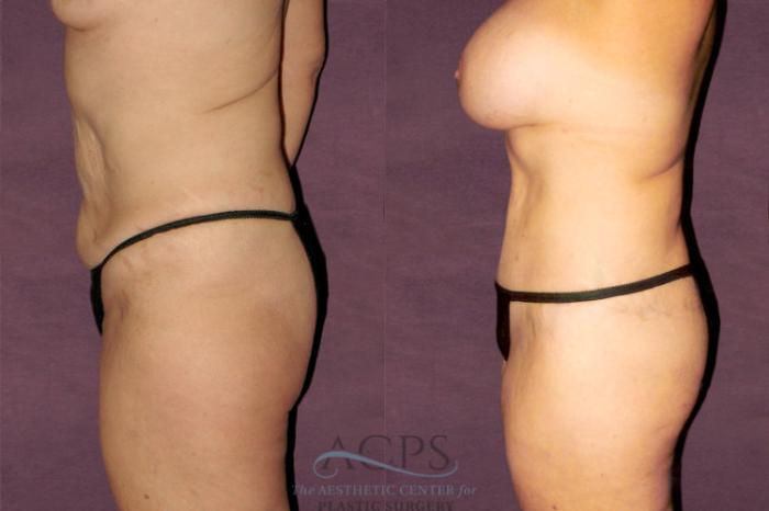Before & After Tummy Tuck Case 153 Oblique Left View: View in Houston, TX