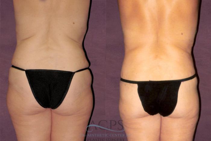 Before & After Tummy Tuck Case 153 Rear View: View in Houston, TX
