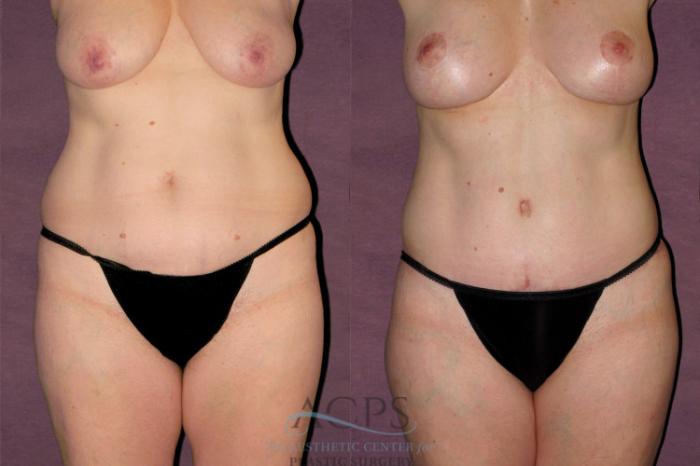 Before & After Tummy Tuck Case 154 Front View: View in Houston, TX