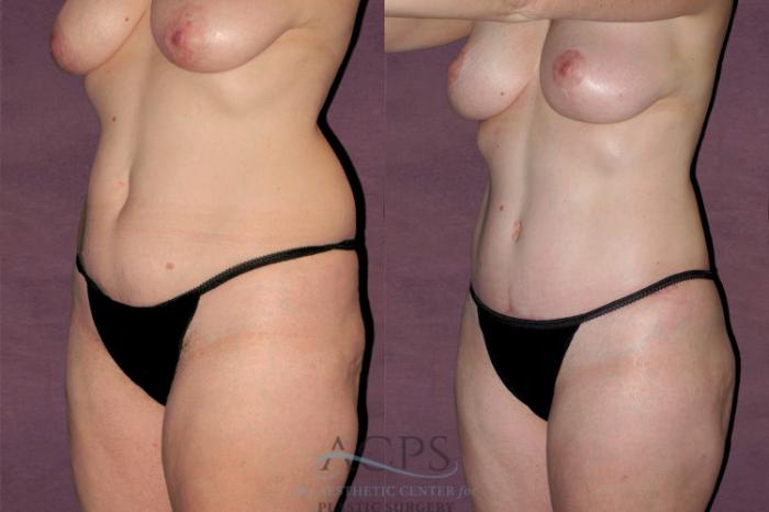 Before & After Tummy Tuck Case 154 Oblique Left View: View in Houston, TX
