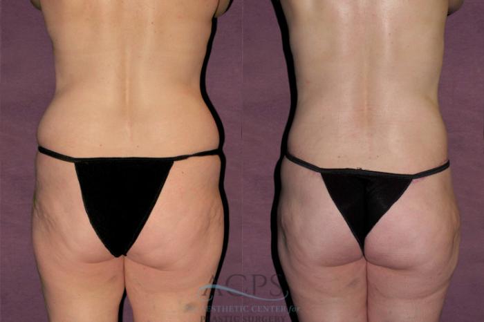 Before & After Tummy Tuck Case 154 Rear View: View in Houston, TX
