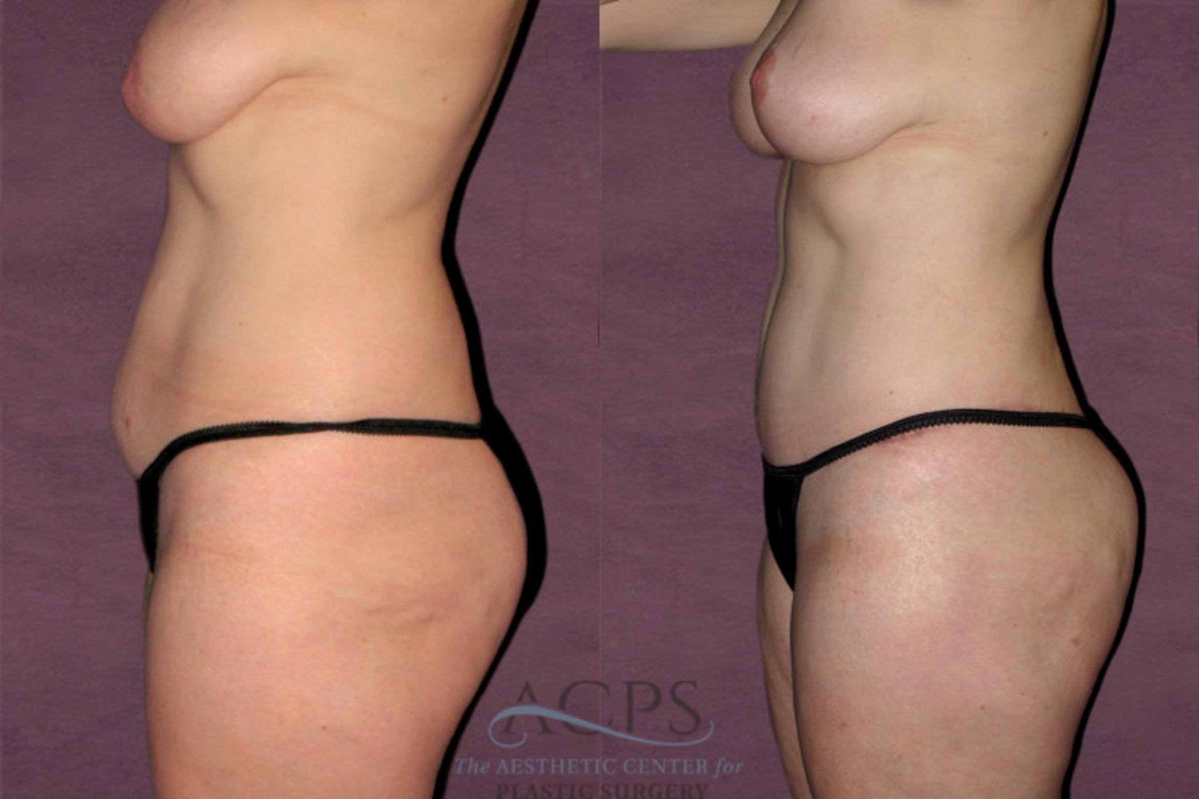 Before & After Tummy Tuck Case 154 Side Left View: View in Houston, TX