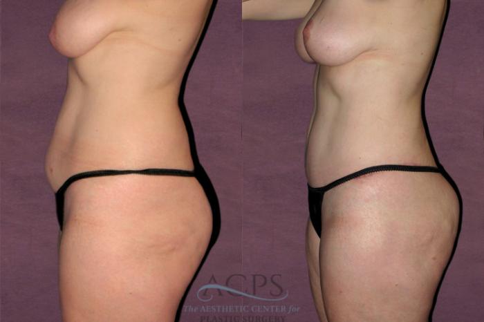 Before & After Tummy Tuck Case 154 Side Left View: View in Houston, TX