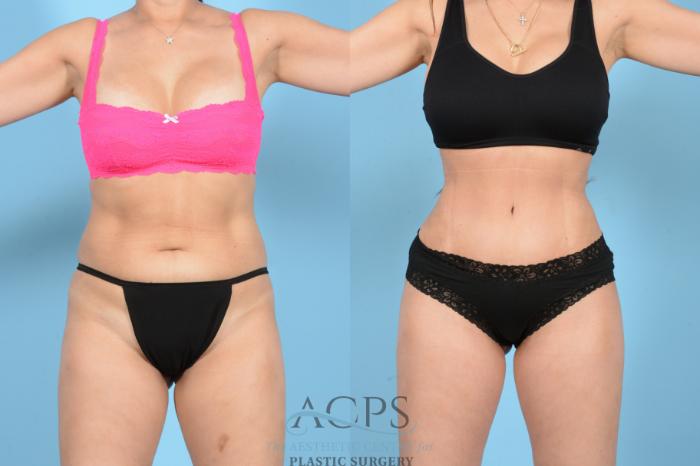 Before & After Tummy Tuck Case 1544 Front View in Houston, TX