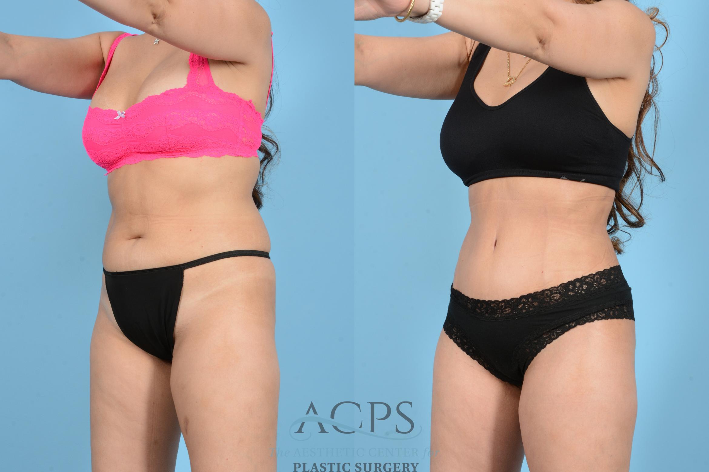 Before & After Tummy Tuck Case 1544 Left Oblique View in Houston, TX