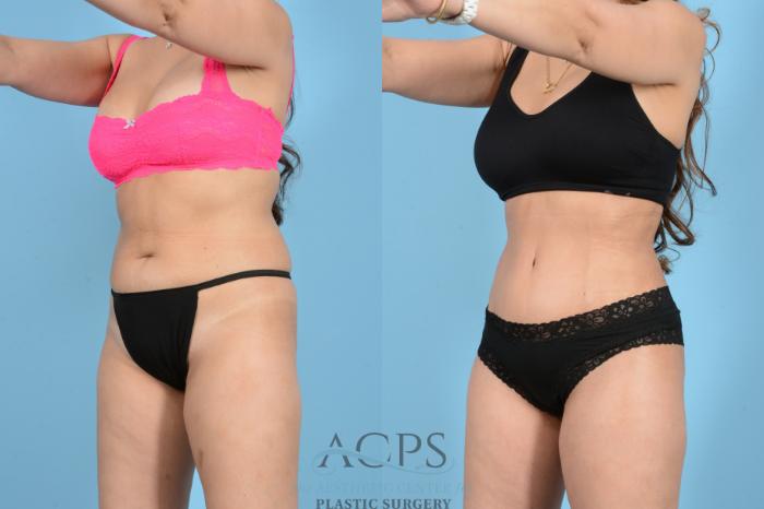 Before & After Tummy Tuck Case 1544 Left Oblique View in Houston, TX